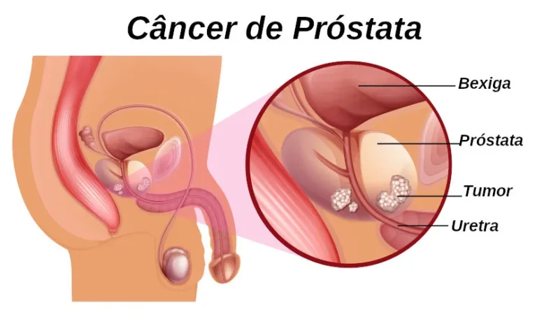 Câncer de próstata – Confira alguns sintomas, causas e tratamento